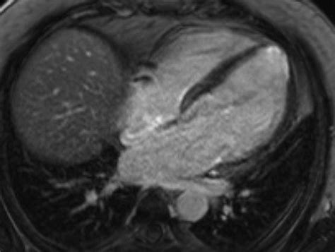 lv thrombus symptoms.